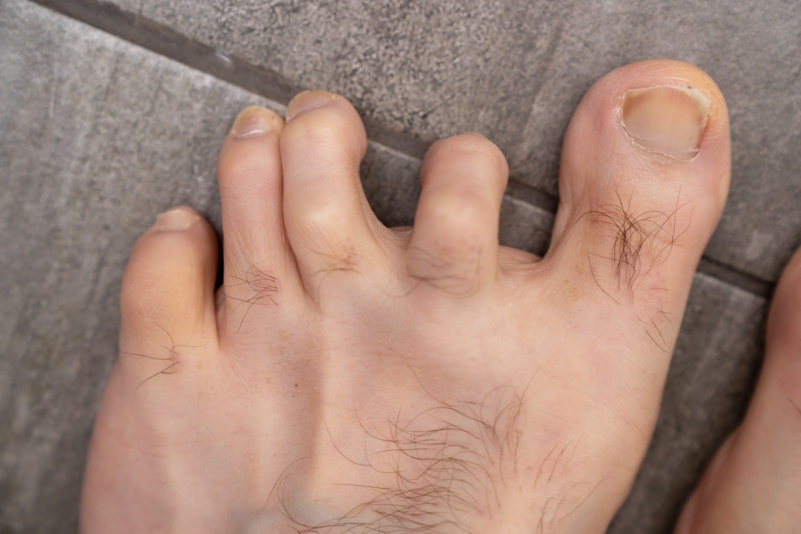 a foot with a hammertoe condition