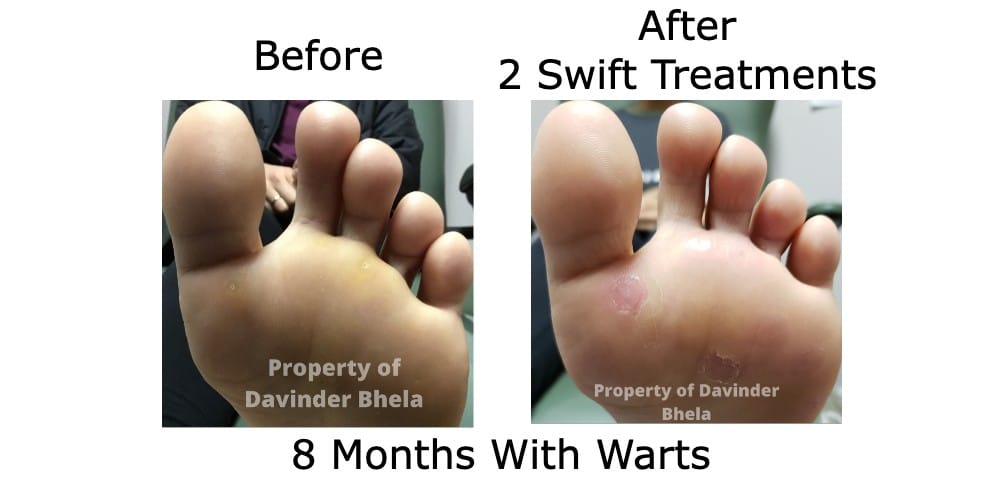Before and After Swift Treatment 5