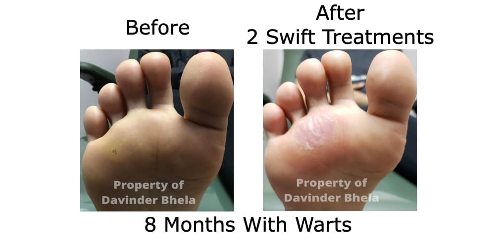 Before and After Swift Treatment 6