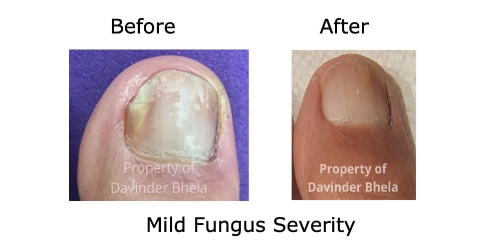 Before and After fungal toenail treatment 2