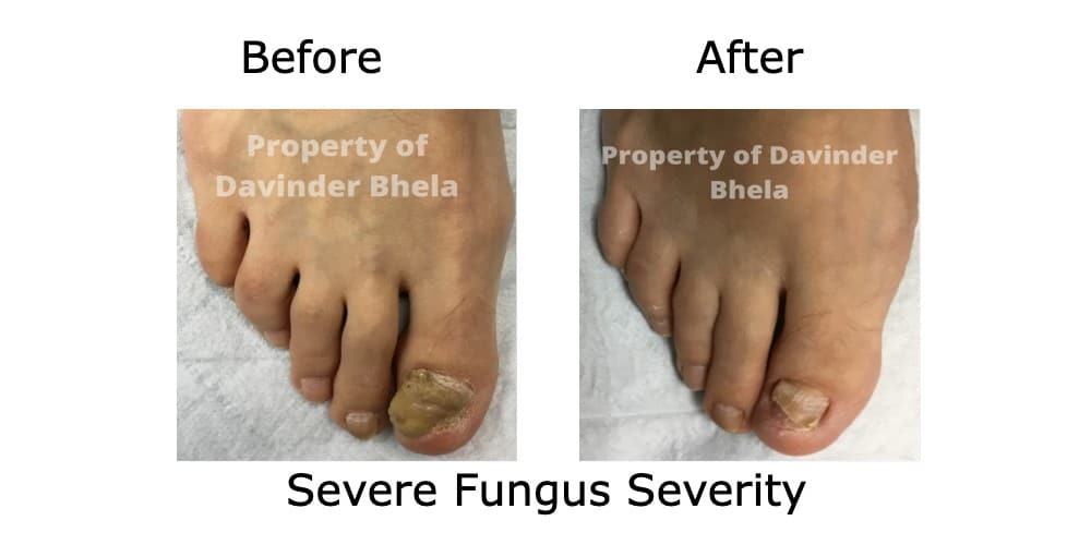 Before and After fungal toenail treatment 4