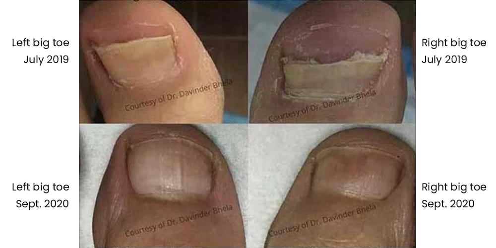 Toenail Fungus Treatment with Lunula Laser Before and After
