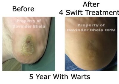 Swift Microwave Therapy - Before and After 4 Treatments