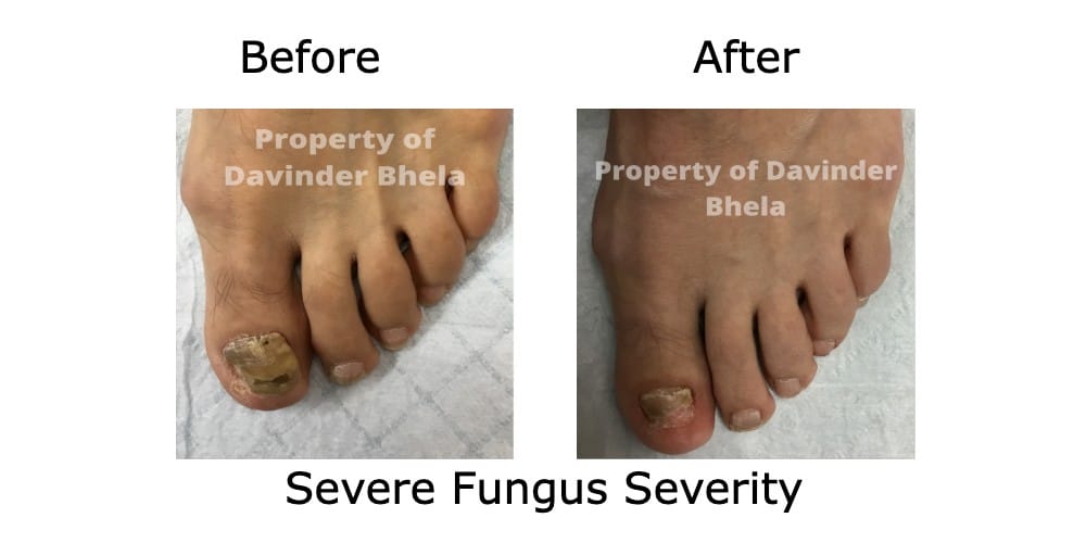 Before and After fungal toenail treatment 3