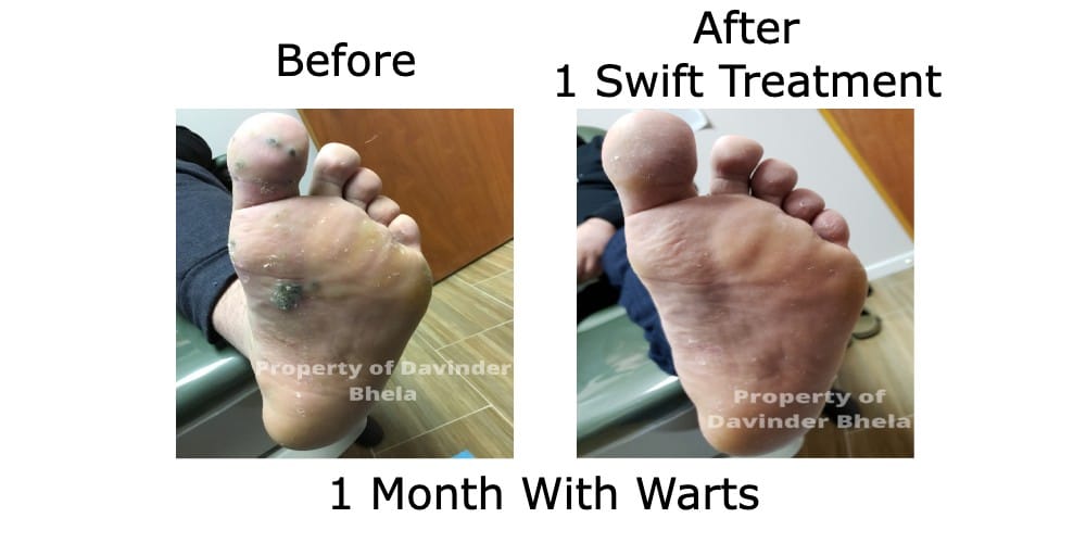 Swift Microwave Therapy - Before and After 1 Treatments