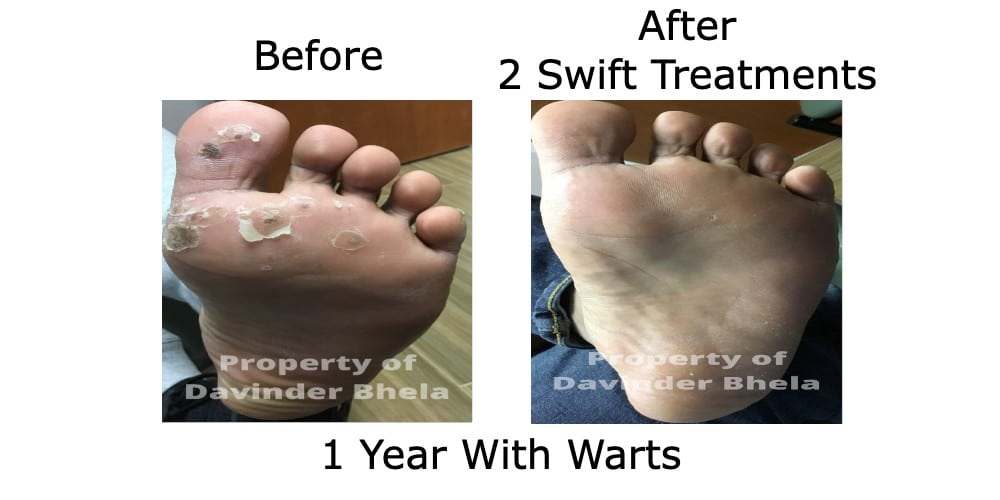 Swift Microwave Therapy - Before and After 2 Treatments