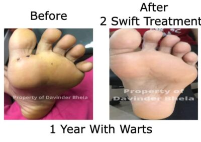 Swift Microwave Therapy - Before and After 2 Treatments
