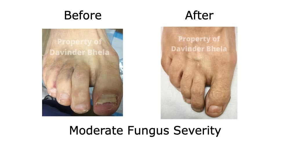 Before and After fungal toenail treatment 1
