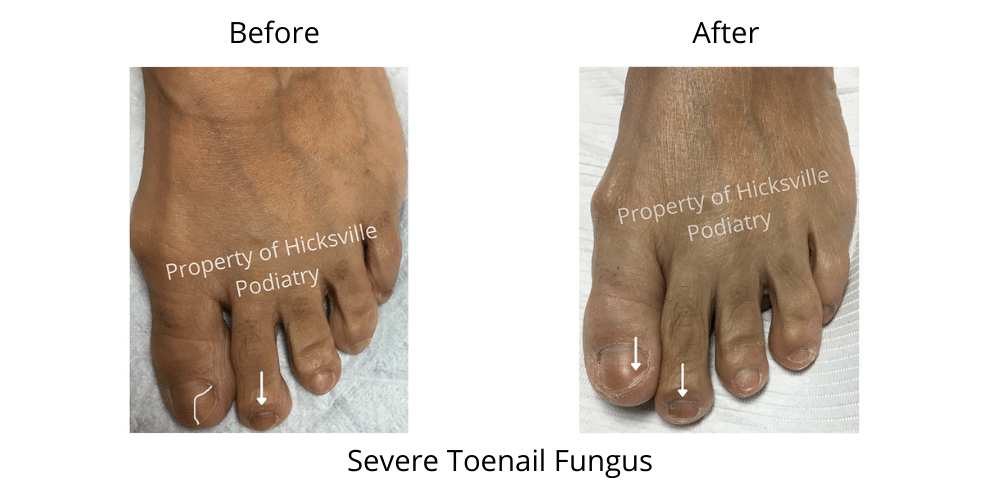 toenail fungus treatment before and after
