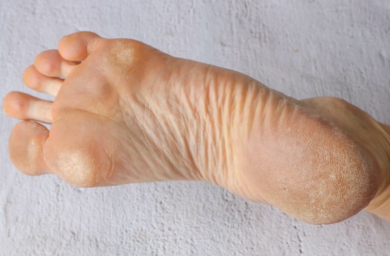 How Swift Therapy Helps Treat Those Stubborn Plantar Warts on Your Feet
