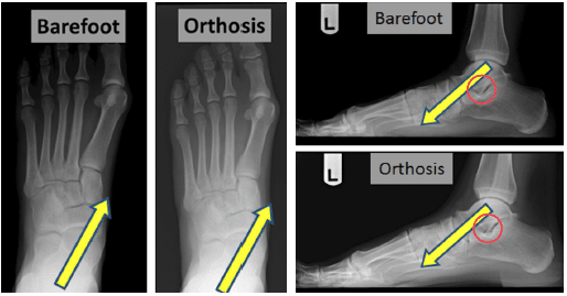 barefoot vs orthosis xray