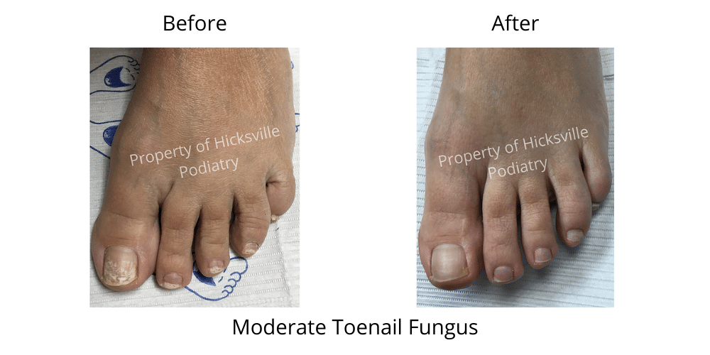 moderate toenail fungus treatment results