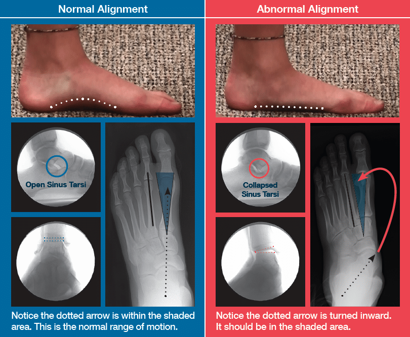normal and abnormal foot chart