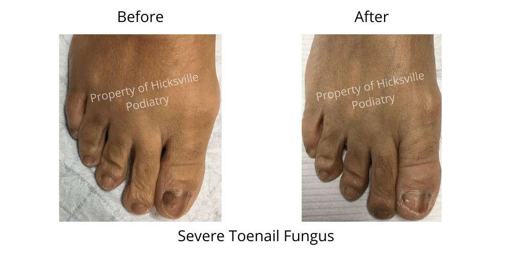 severe toenail fungus treatment resutls