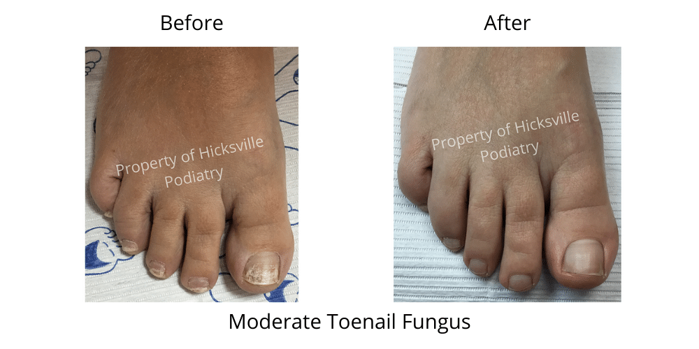 toenail fungus treatment results