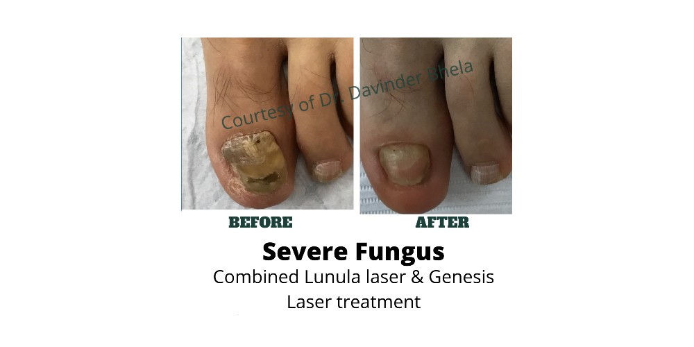 Luna and Genesis Lasers Before and After