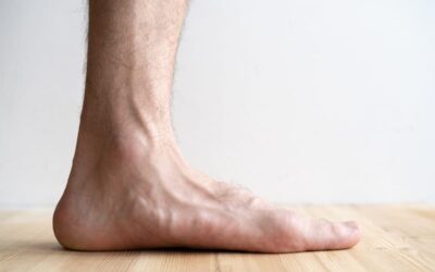 Should I Get the HyProCure Treatment for Flat Feet?