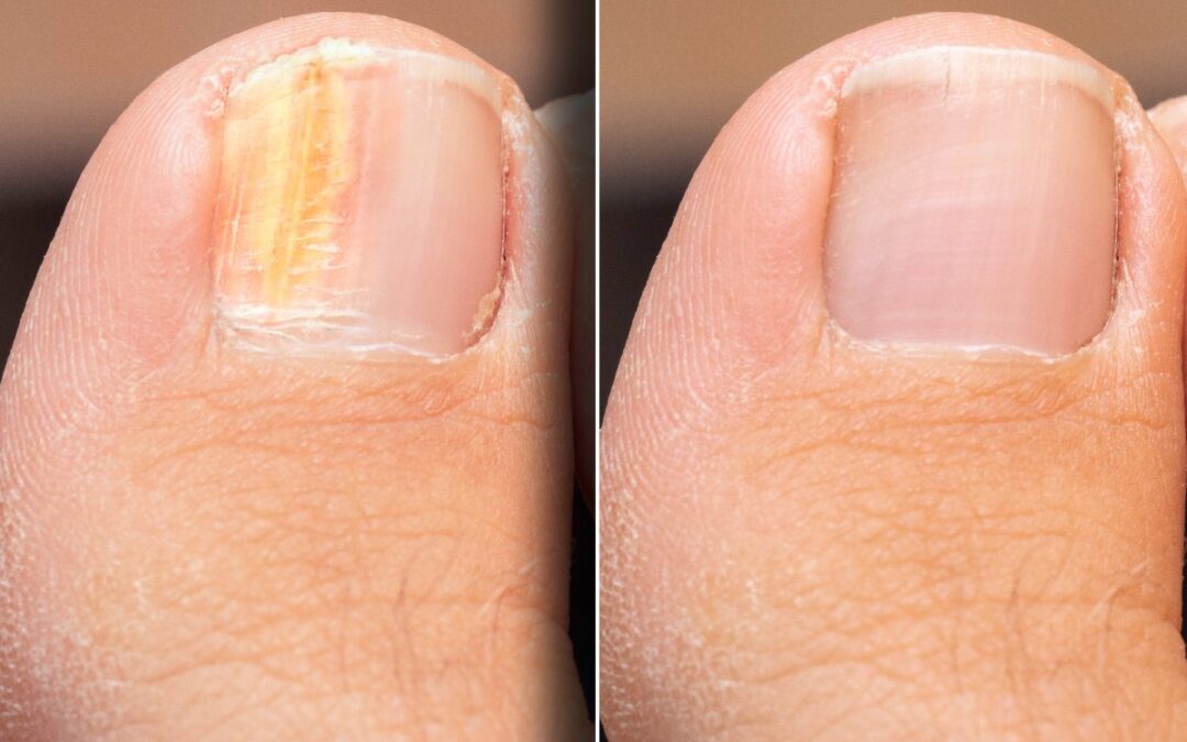 Everything You Need to Know to Treat Your Toenail Fungus