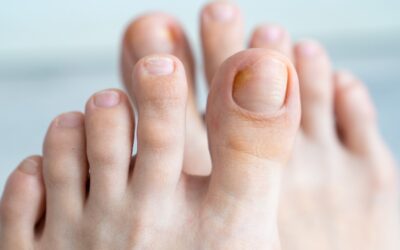 Laser Therapy for Fungal Toenails