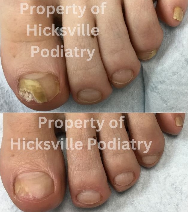 Toenail Fungus Before & After Photos | Hicksville Podiatry