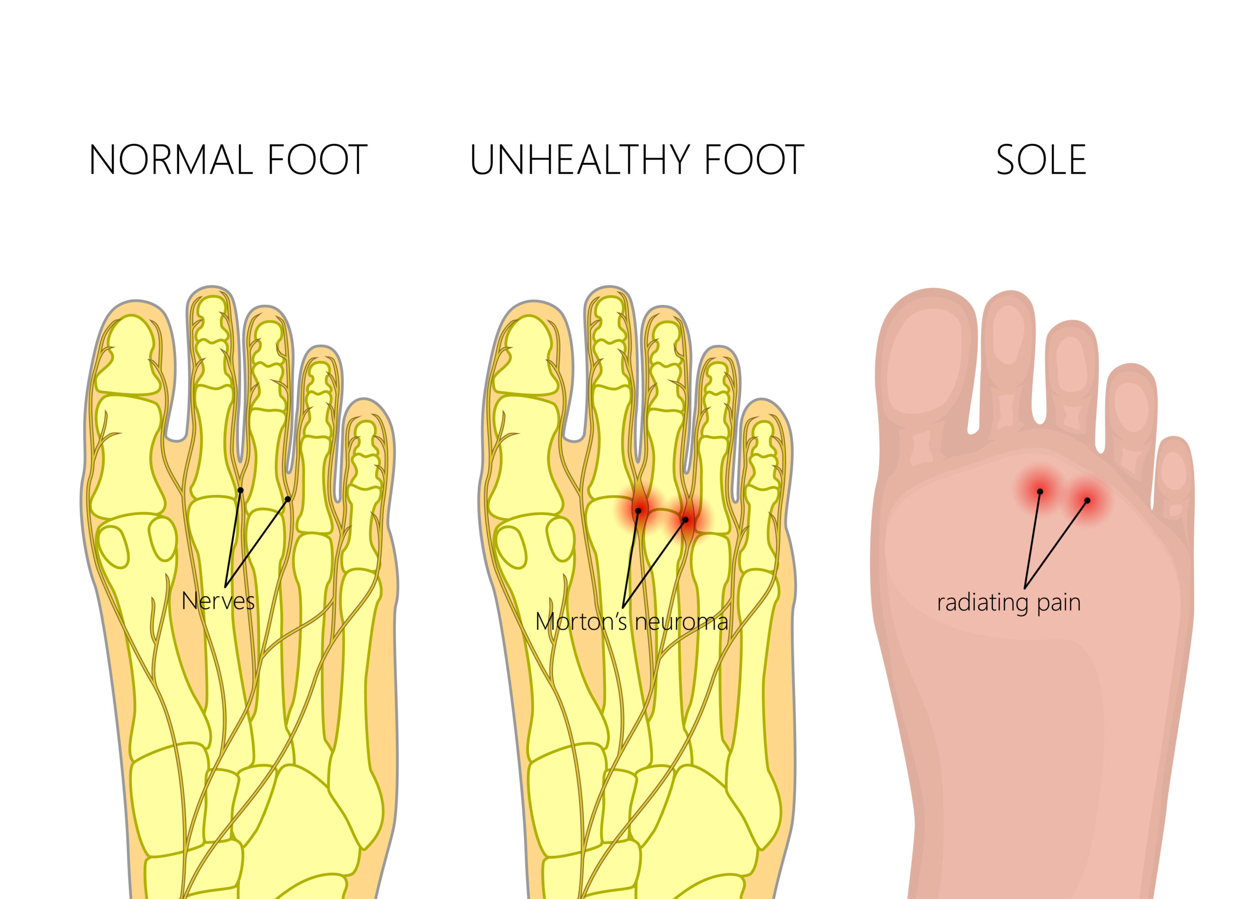 Person holding foot due to foot pain caused by a neuroma